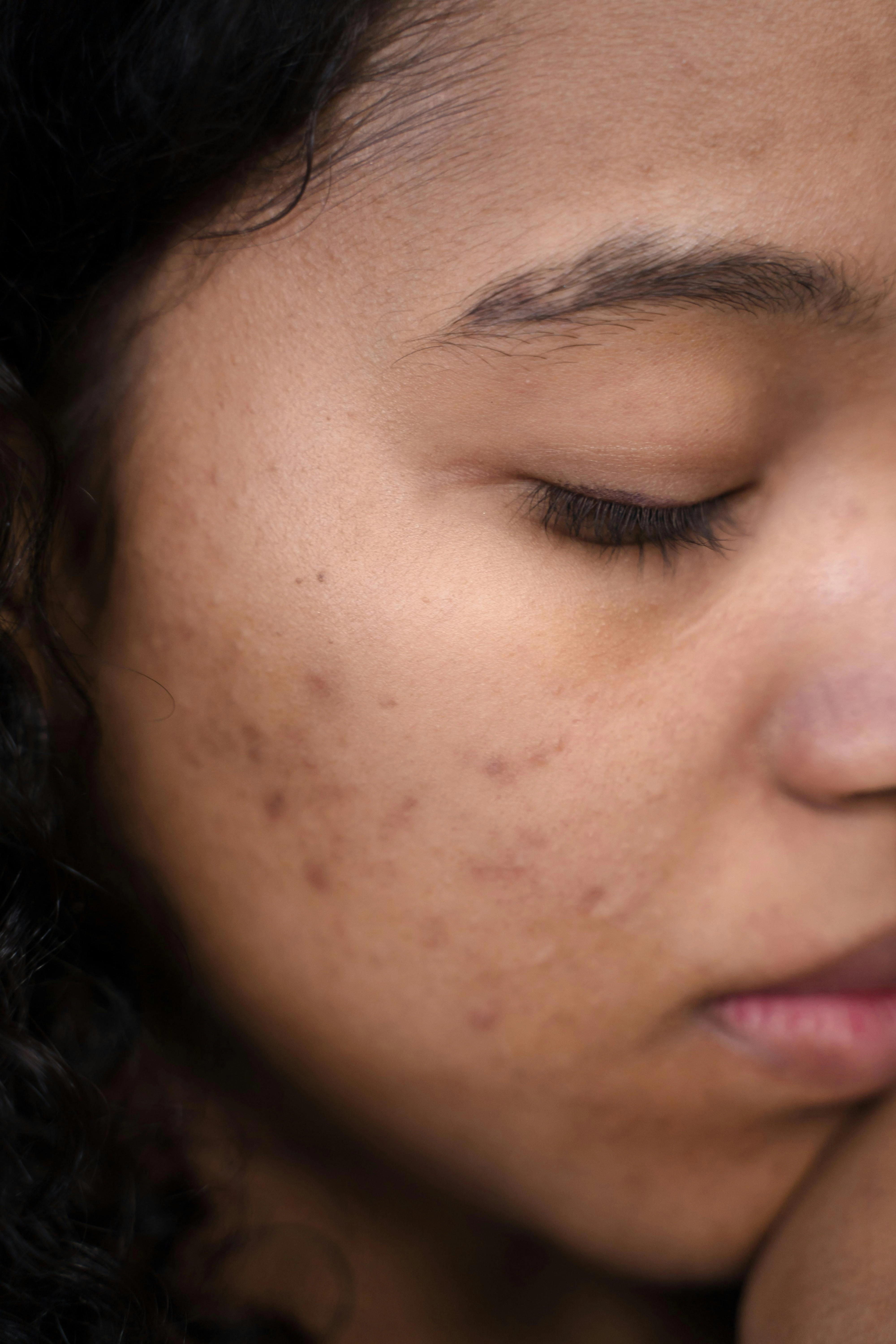 Acne & Acne Scars