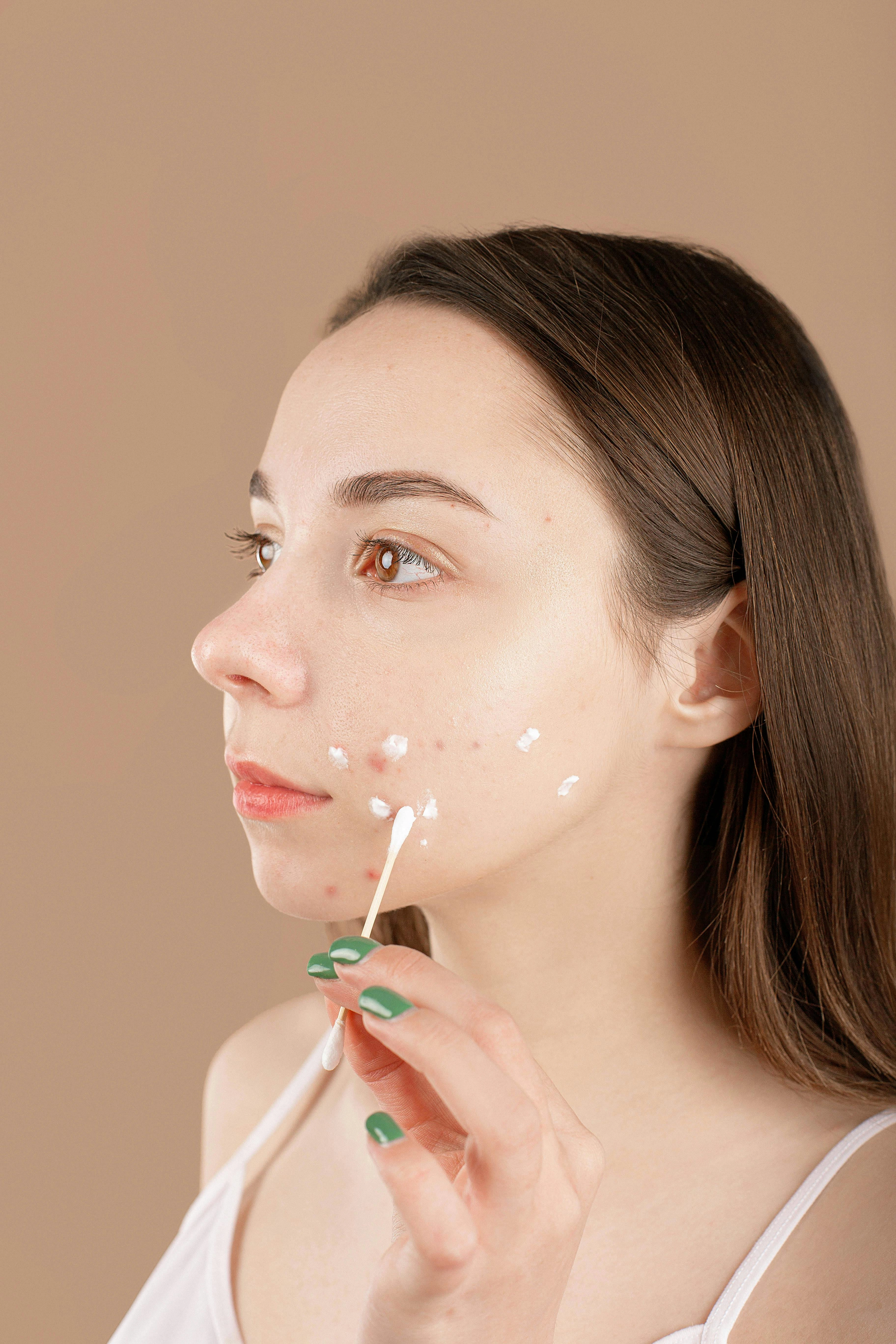 Acne & Acne Scars