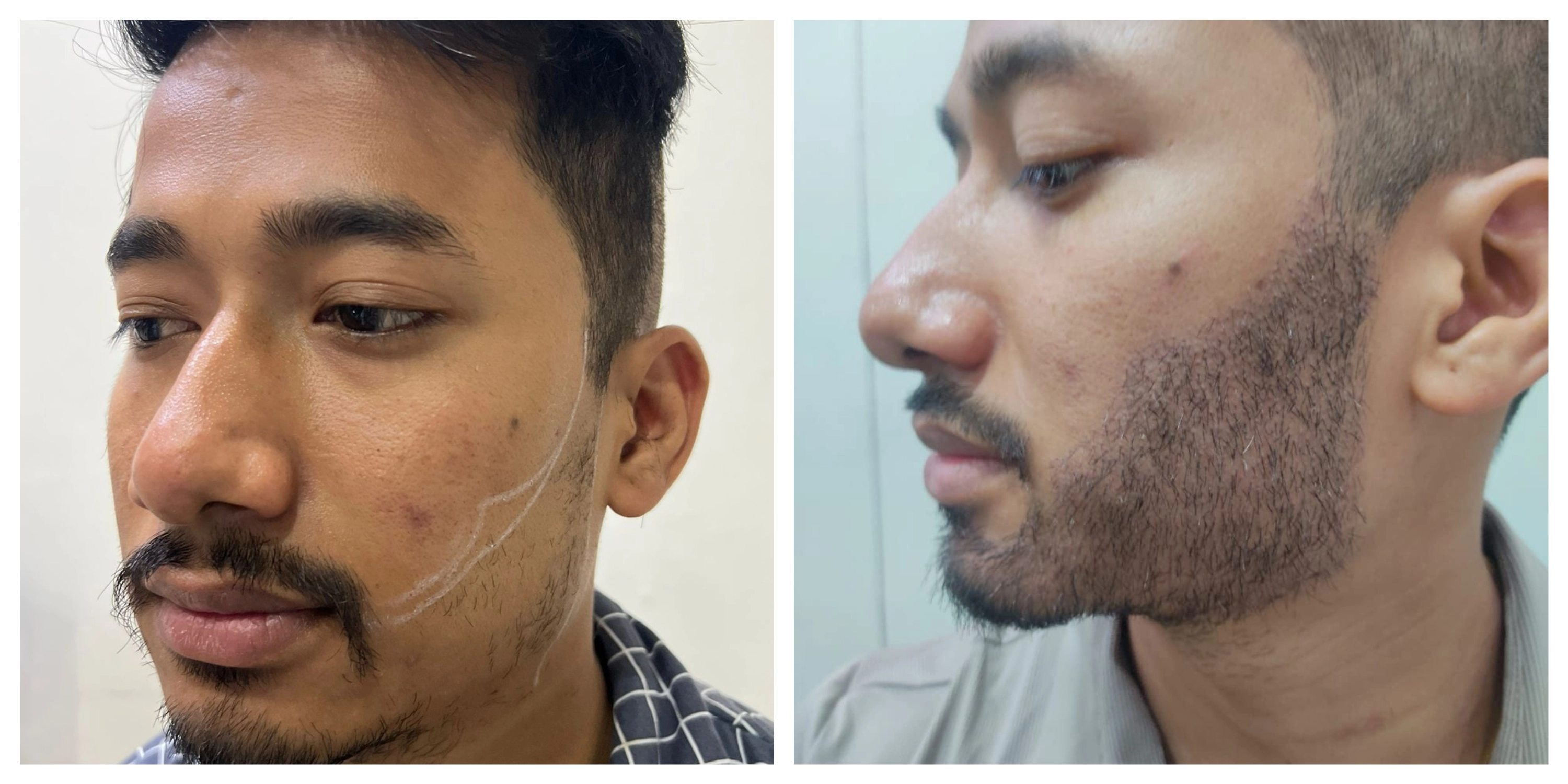 	Beard Transplant
