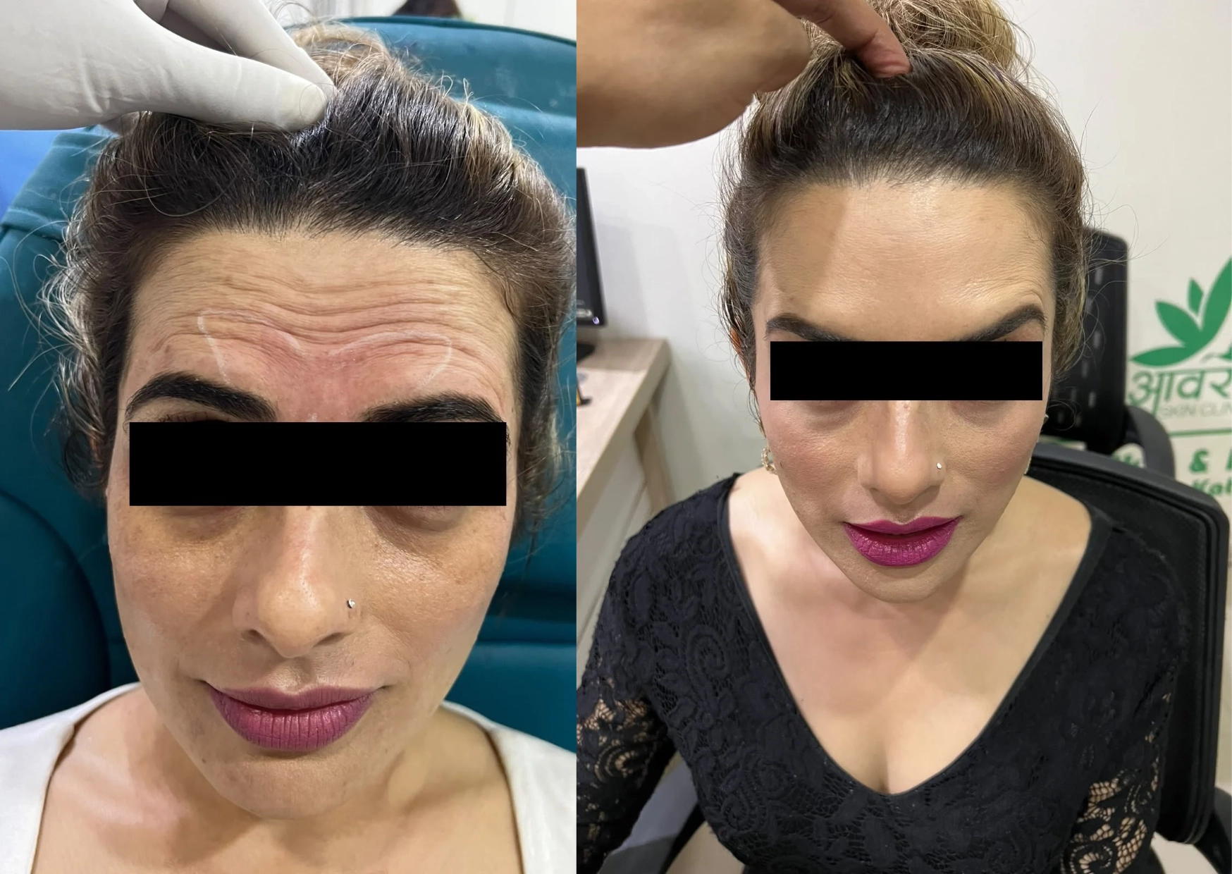 Botox Treatment