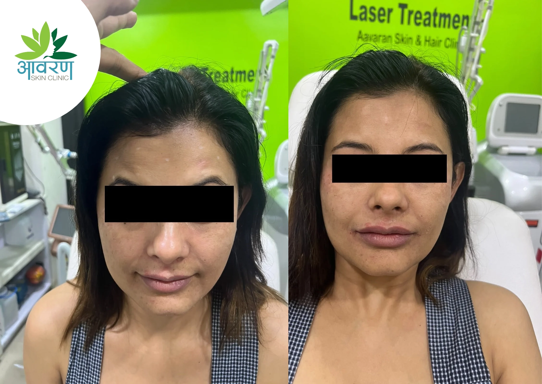 Dermal Fillers