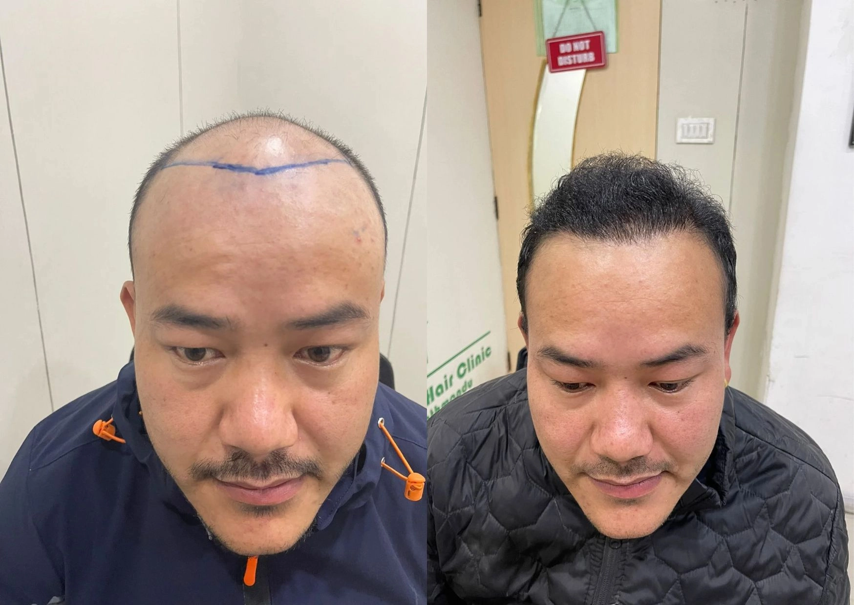 Hair Transplant