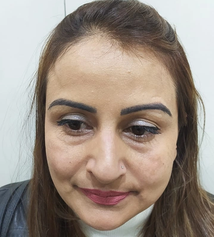 Melasma Treatment