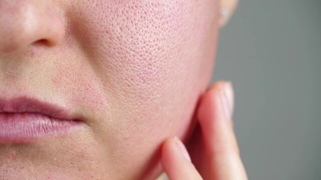 Open Pores & Oily Skin