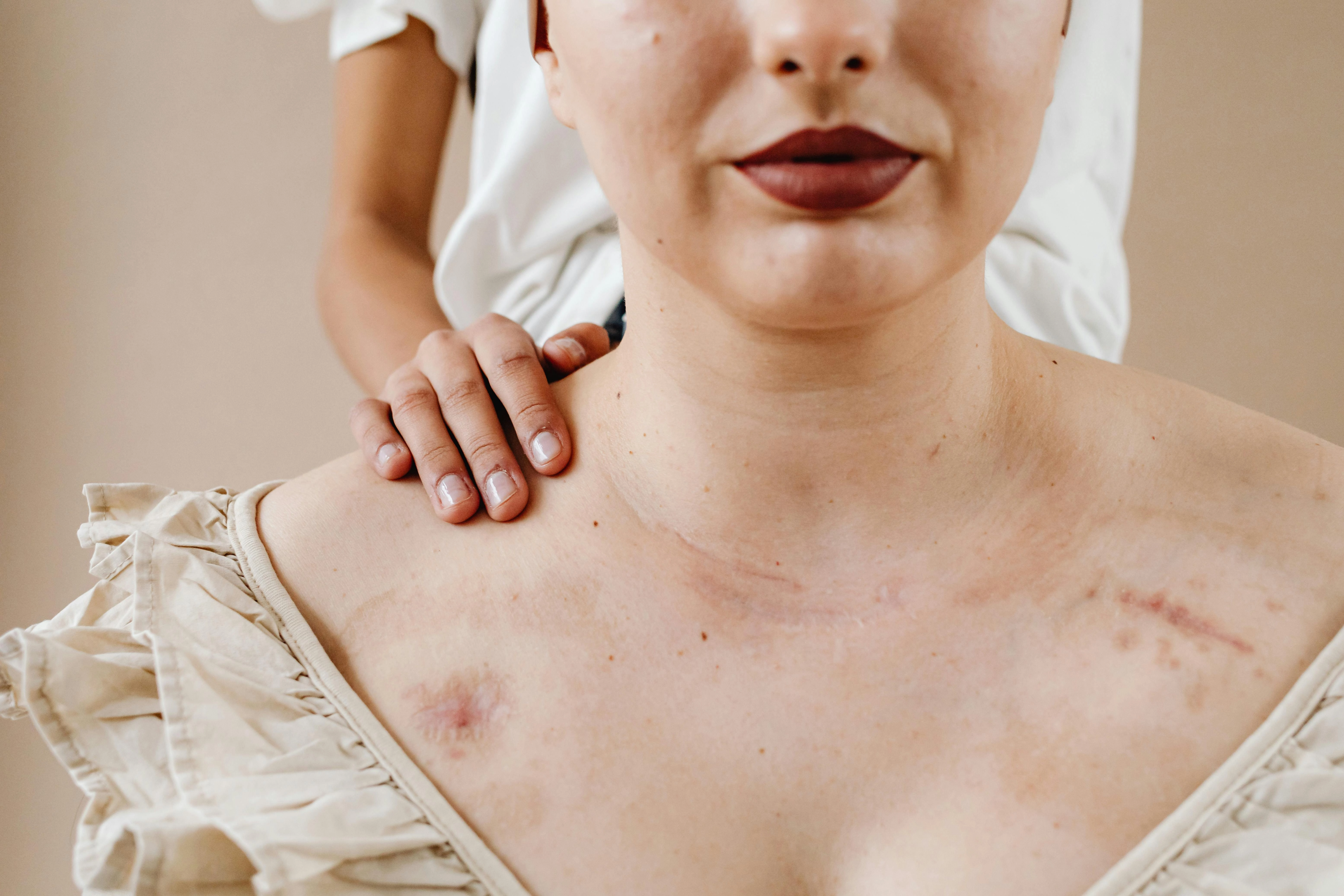 	Scar Revision
