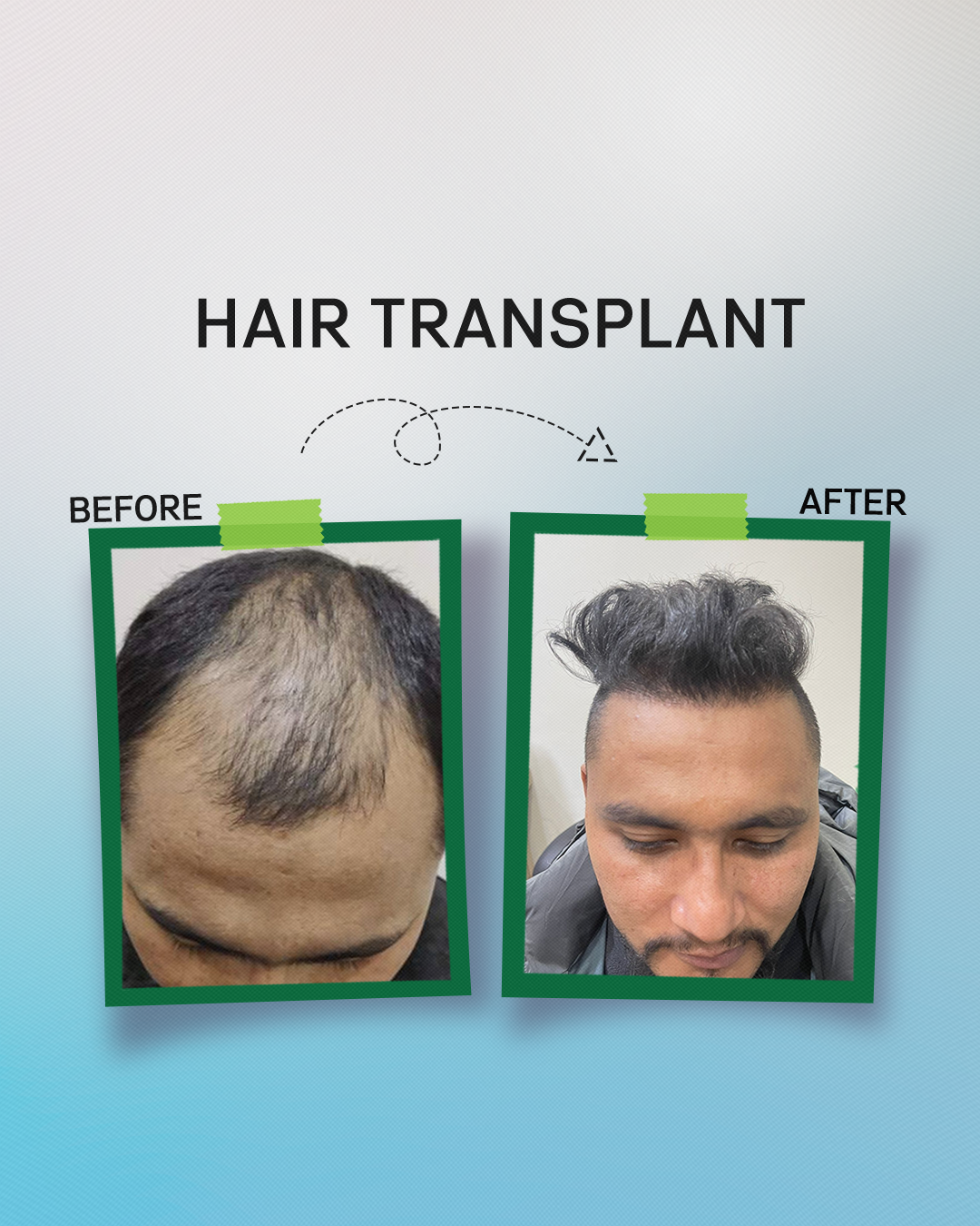 Hair Transplant Success