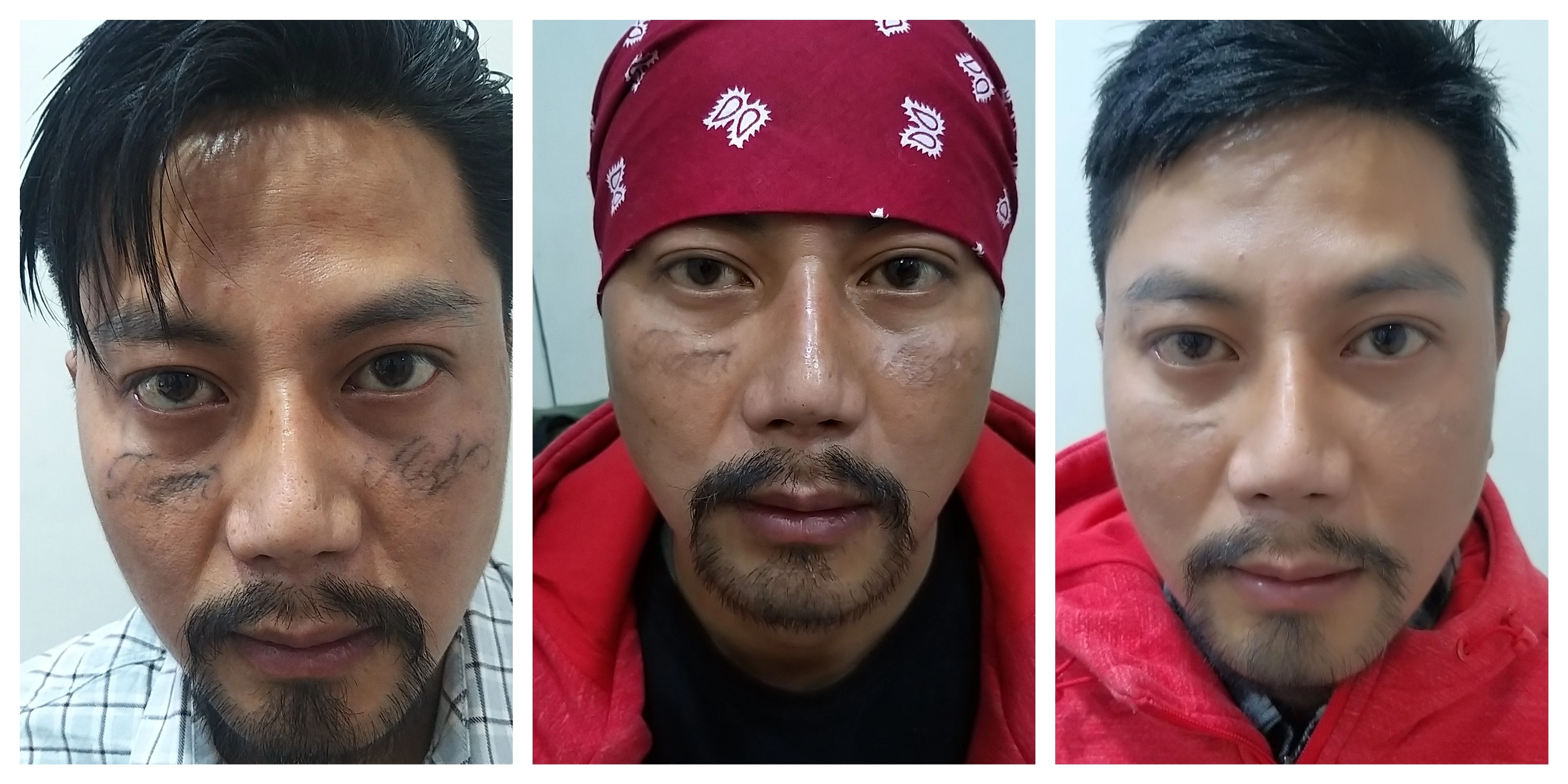 Successful Facial Tattoo Removal